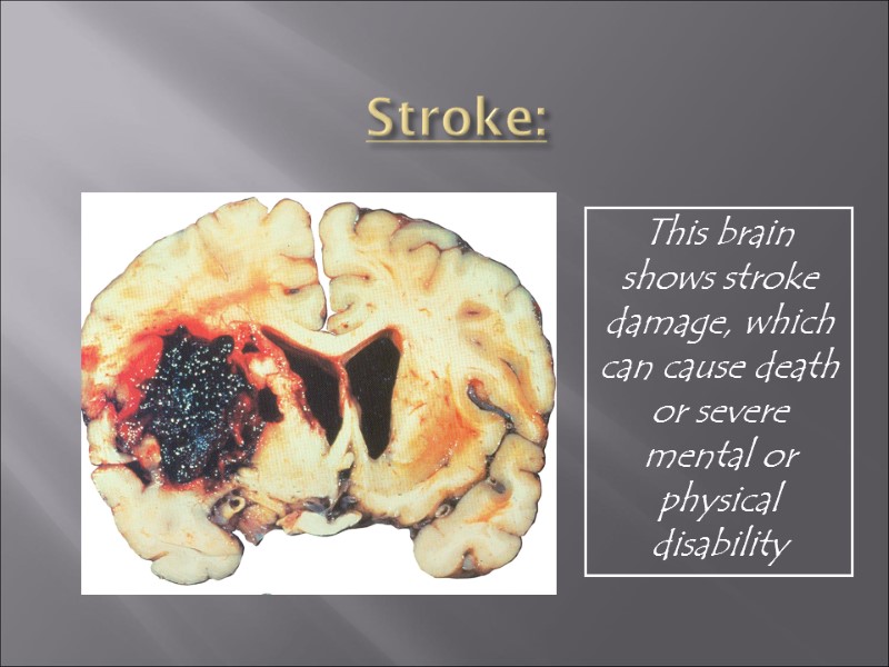 Stroke: This brain shows stroke damage, which can cause death or severe mental or